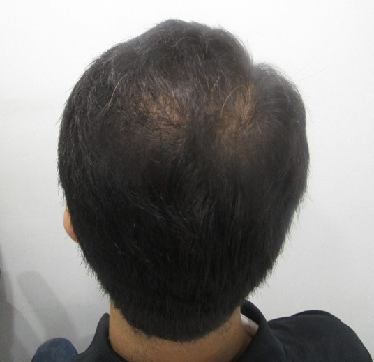 Hair loss treatment Before - Aditya @olivaclinic