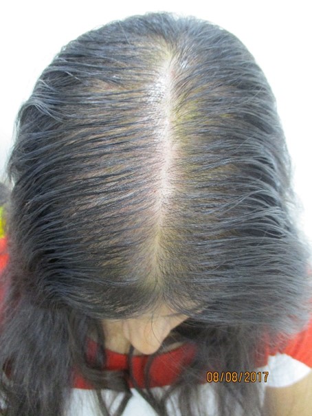 Hair loss treatment Before - Anvesha @olivaclinic