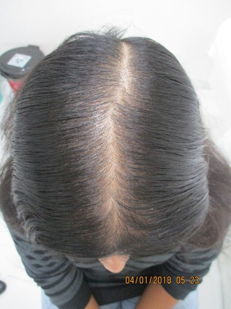 Hair loss treatment After - Anvesha @olivaclinic
