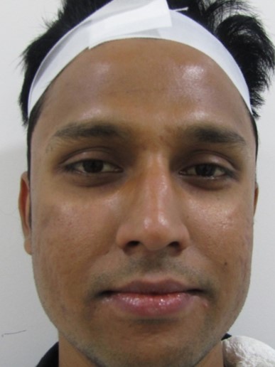 Acne scar treatment After - Arun @olivaclinic