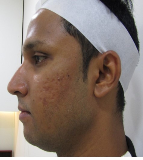 Acne scar treatment Before - Arun @olivaclinic