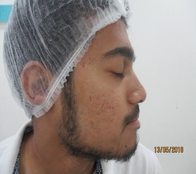 Acne treatment After - Atifuddin @olivaclinic