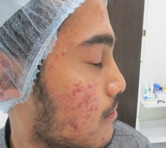 Acne treatment Before - Atifuddin @olivaclinic