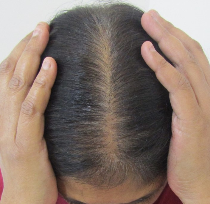 Hair loss treatment After - Baby @olivaclinic