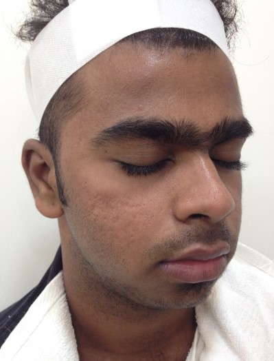 Acne scar treatment After - Balaji @olivaclinic