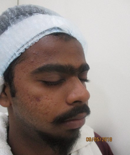 Acne scar treatment Before - Balaji @olivaclinic