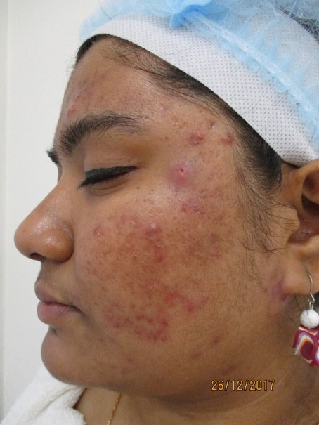 Acne treatment Before - Dhana @olivaclinic