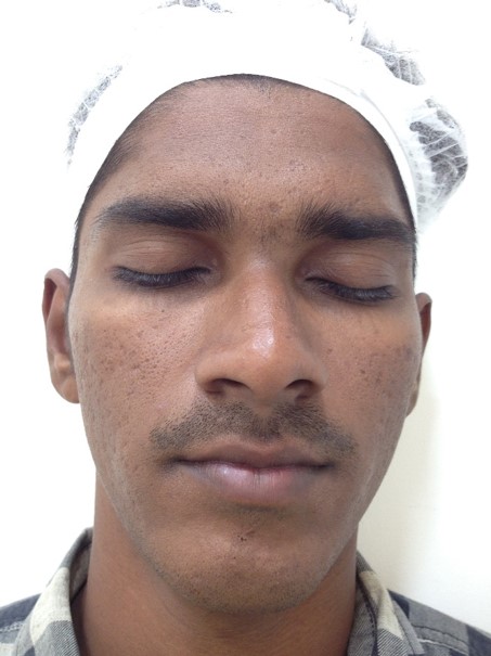 Skin lightening treatment After - Dharani @olivaclinic