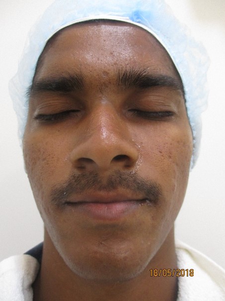 Skin lightening treatment Before - Dharani @olivaclinic