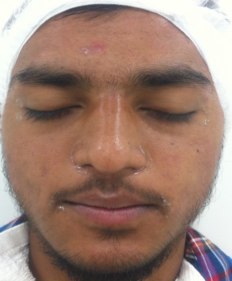 Acne treatment After - Durgesh @olivaclinic