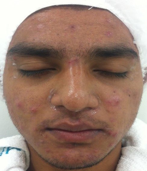 Acne treatment Before - Durgesh @olivaclinic