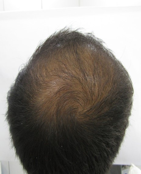 Hair loss treatment Before - Gaurav @olivaclinic
