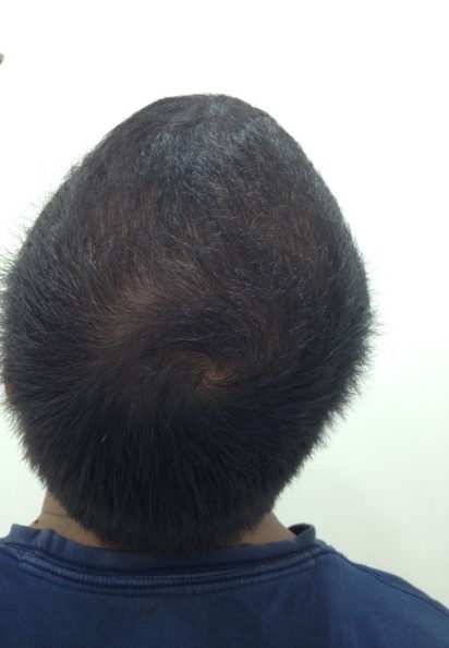 Hair loss treatment After - Gaurav @olivaclinic