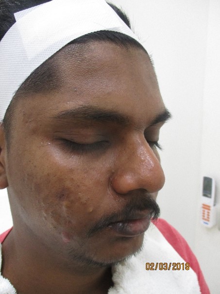 Acne treatment Before - Gopinath @olivaclinic