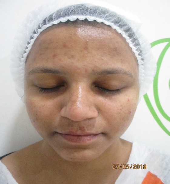 Acne treatment After - Harika @olivaclinic