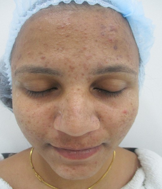 Acne treatment Before - Harika @olivaclinic
