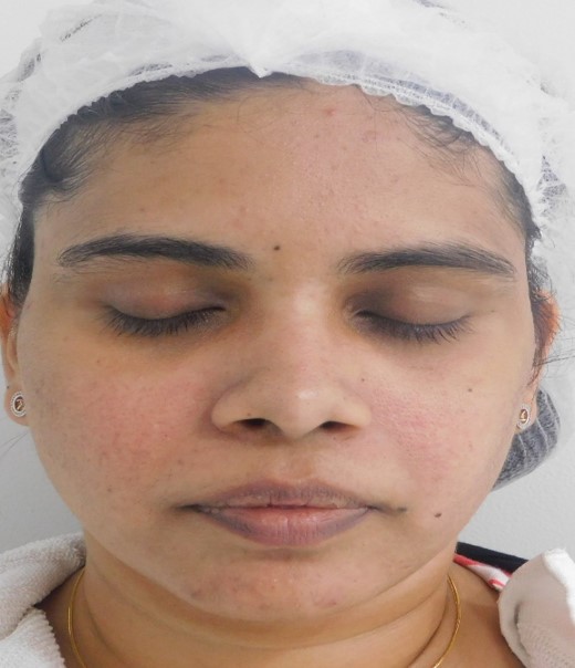 Acne scar treatment After - Hephzibah @olivaclinic