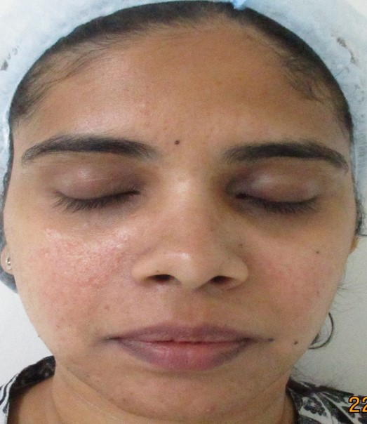 Acne scar treatment Before - Hephzibah @olivaclinic