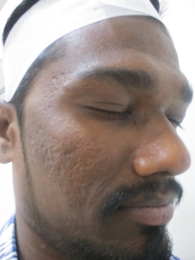 Acne scar treatment After - Kadappan @olivaclinic
