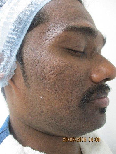 Acne scar treatment Before - Kadappan @olivaclinic