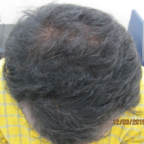 Hair loss treatment After - Kiran @olivaclinic