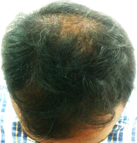 Hair loss treatment Before - Kiran @olivaclinic