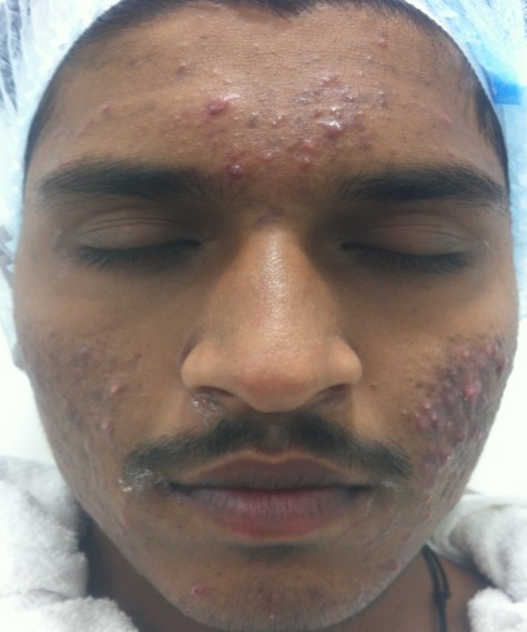 Acne treatment Before - Madhav @olivaclinic