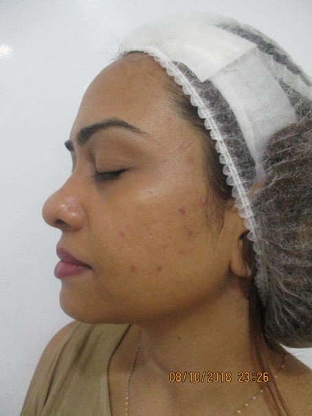 Acne scar treatment After - Maheen @olivaclinic