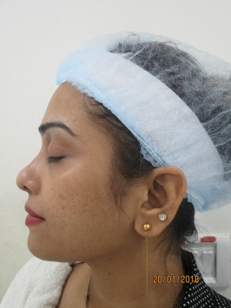 Acne scar treatment Before - Maheen @olivaclinic