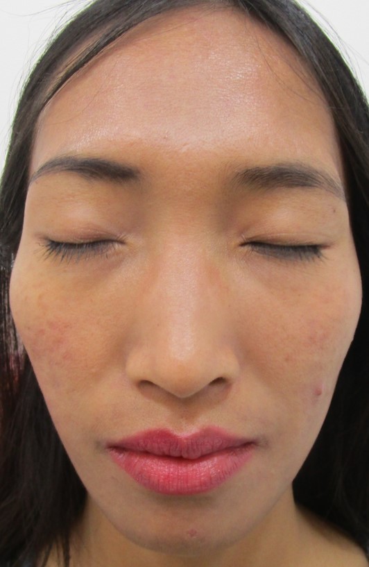 Acne treatment After - Manmeikim @olivaclinic