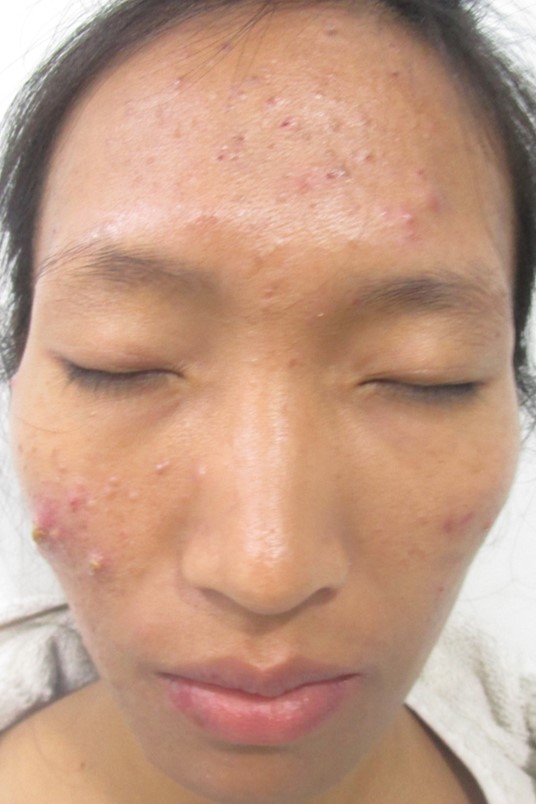 Acne treatment Before - Manmeikim @olivaclinic
