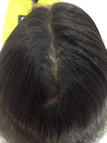 Hair loss treatment After - Masthana @olivaclinic