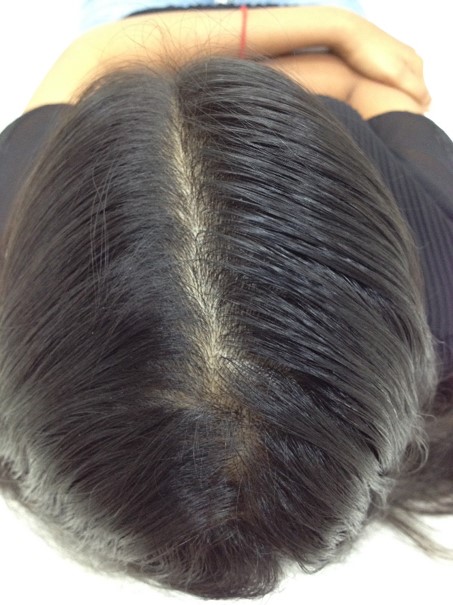 Hair loss treatment Before - Masthana @olivaclinic