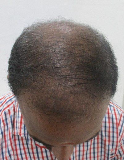 Hair loss treatment Before - Muthukumaran @olivaclinic