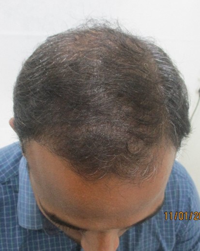 Muthukumaran after PRP hair treatment Photo