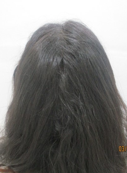 Hair loss treatment After - Nisha @olivaclinic