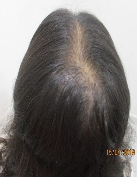 Hair loss treatment Before - Nisha @olivaclinic