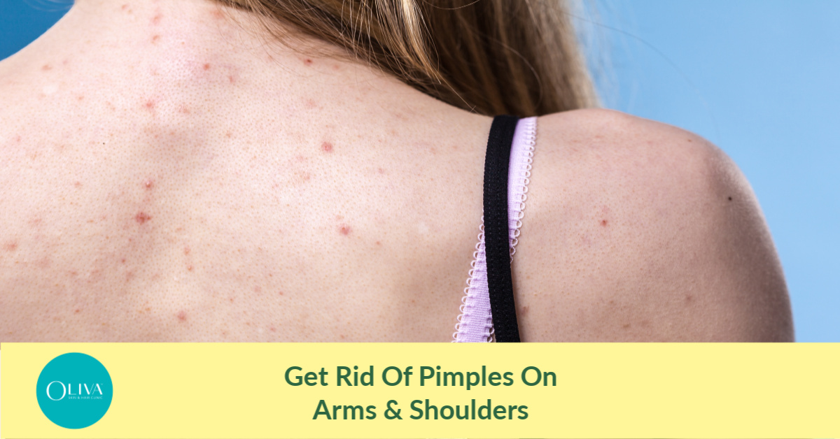 How To Remove Pimples From Arms & Shoulders?