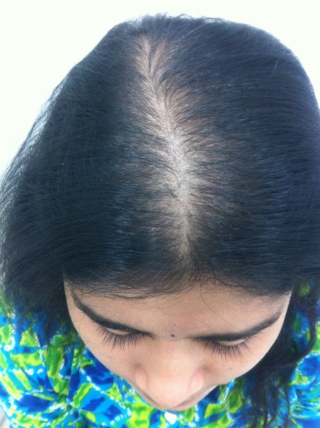 Hair loss treatment After - Priya @olivaclinic