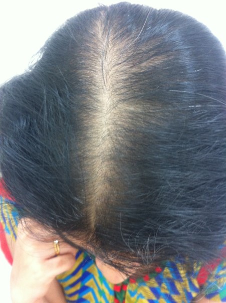 Hair loss treatment Before - Priya @olivaclinic