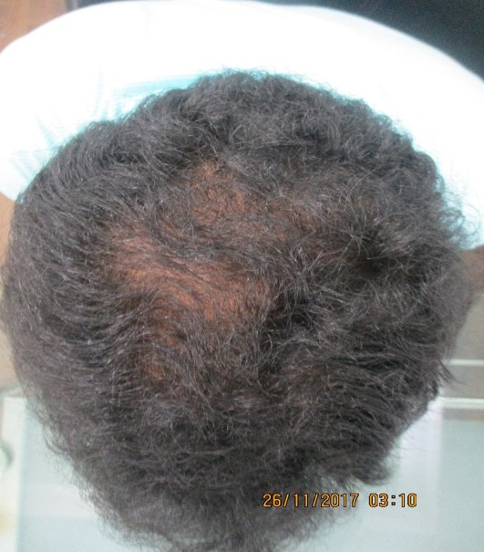 Rakesh Babu PRP Hair treatment Before
