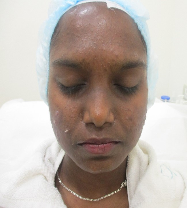 Acne treatment Before - Revathi @olivaclinic