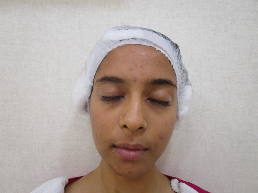 Acne treatment After - Roshni @olivaclinic