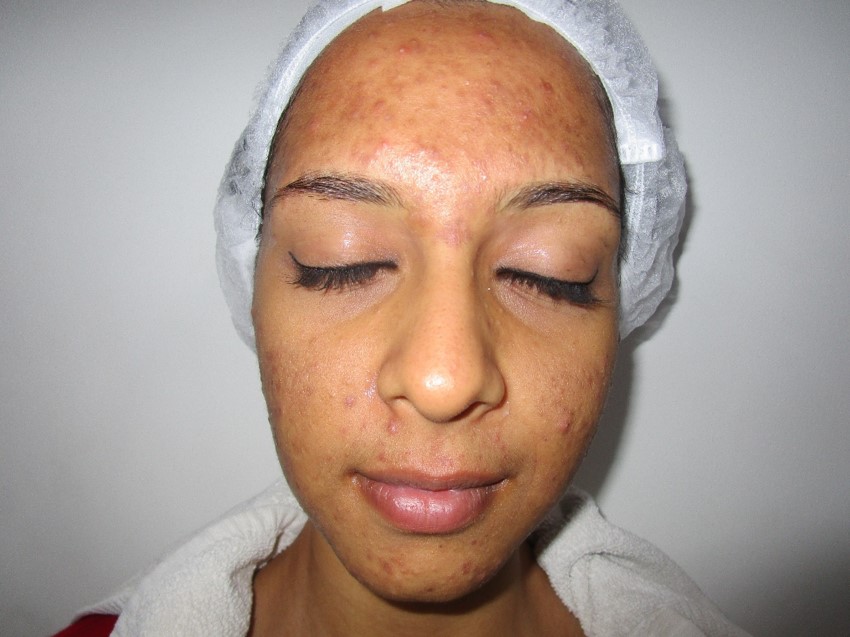 Acne treatment Before - Roshni @olivaclinic