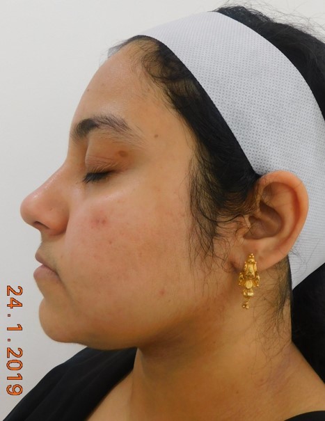 Acne scar treatment After - Saba @olivaclinic