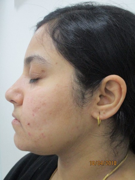 Acne scar treatment Before - Saba @olivaclinic