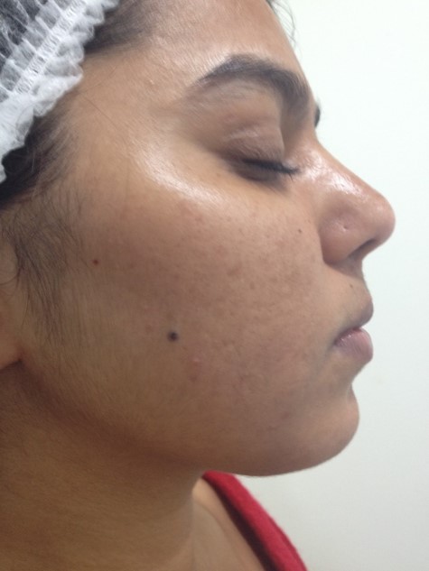 Skin lightening treatment Before - Sana @olivaclinic