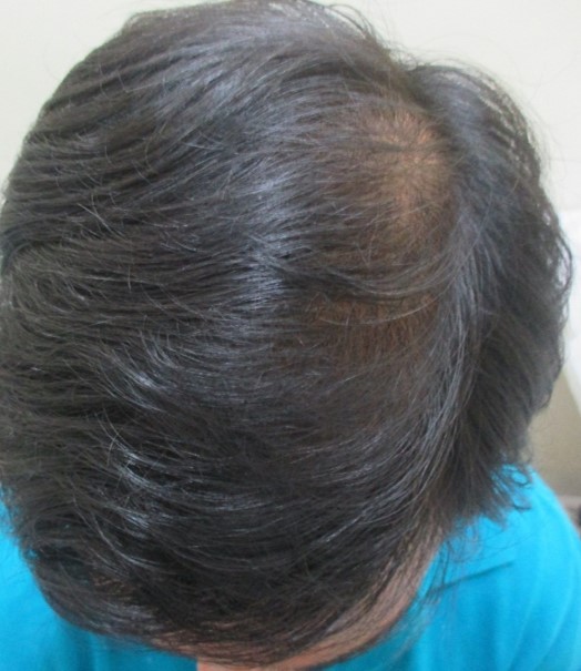 Hair loss treatment After - Sangamesh @olivaclinic