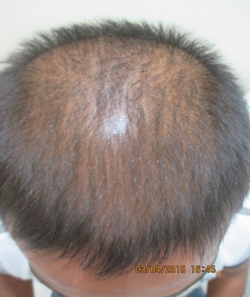 Hair loss treatment Before - Sangamesh @olivaclinic