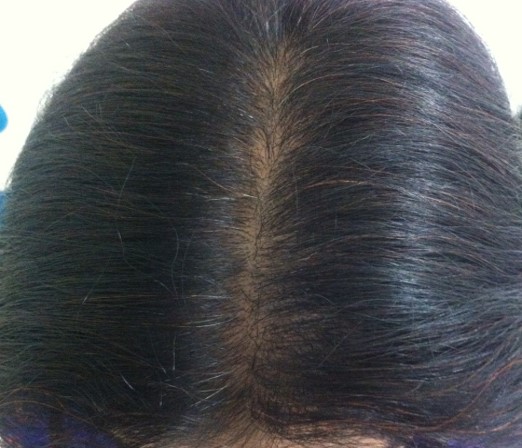 Hair loss treatment After - Shalani @olivaclinic